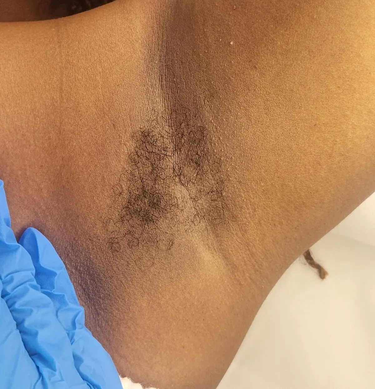 Before and after underarm waxing at Beauty by Haks — before